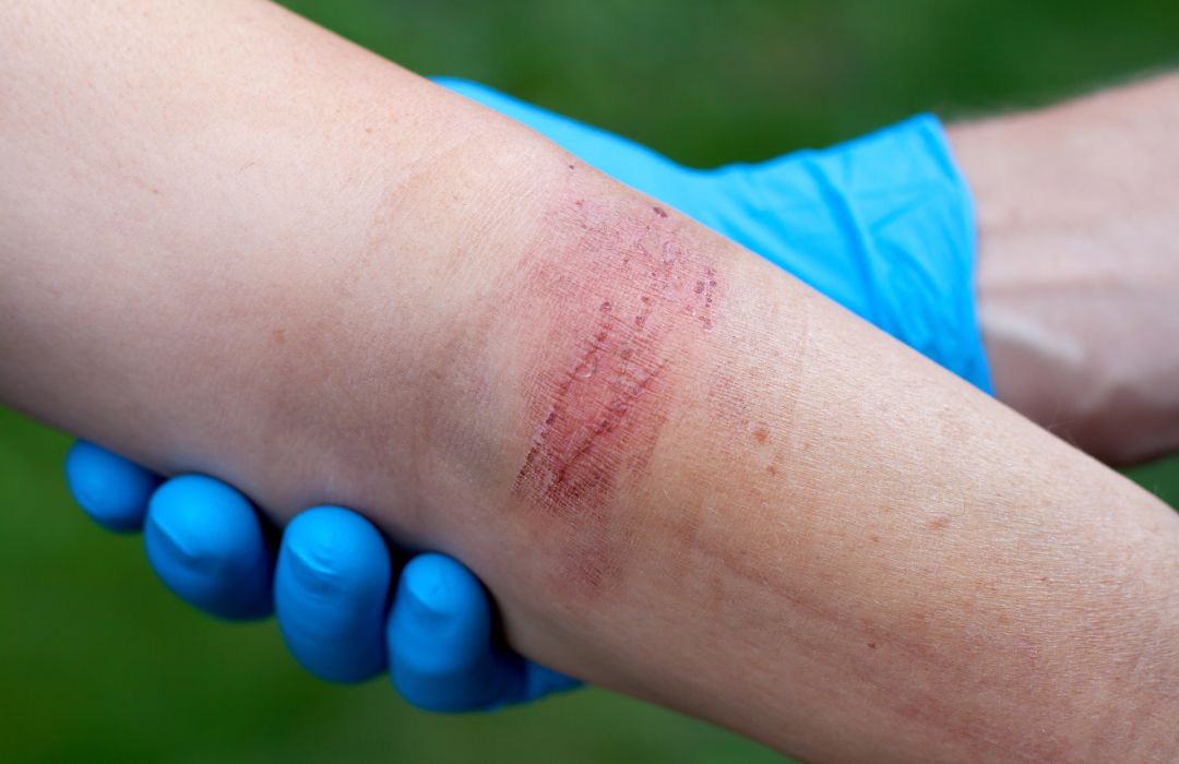 איך לטפל בכוויה